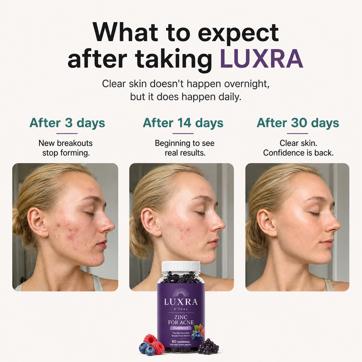 LUXRA Acne Gummies